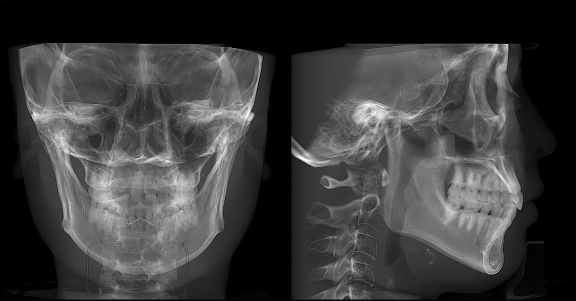 單側(cè)頭影測(cè)量