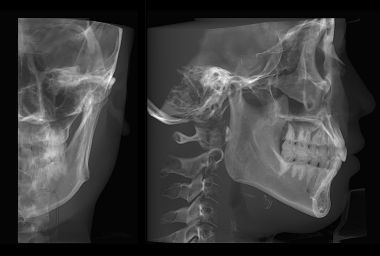 單側(cè)頭影測(cè)量